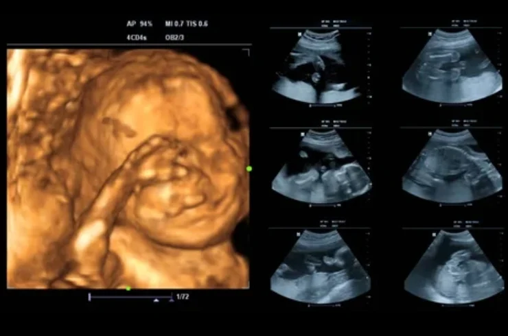 Ultrasound Scans